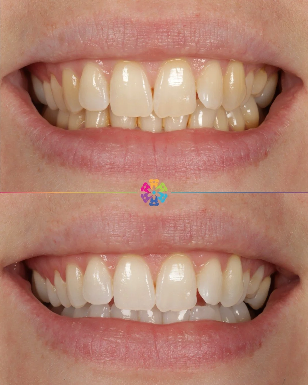 Whitening Transformation ✨

For a natural, brighter smile 

#dentalsmiles #dentalsmilesflagstaff #dentalsmilesessex #flagstaffcolchester #colchesterdentist #dedicatednervouspatients #naturalsmile #nervous #sedation #teethwhitening #nervouspatient #de