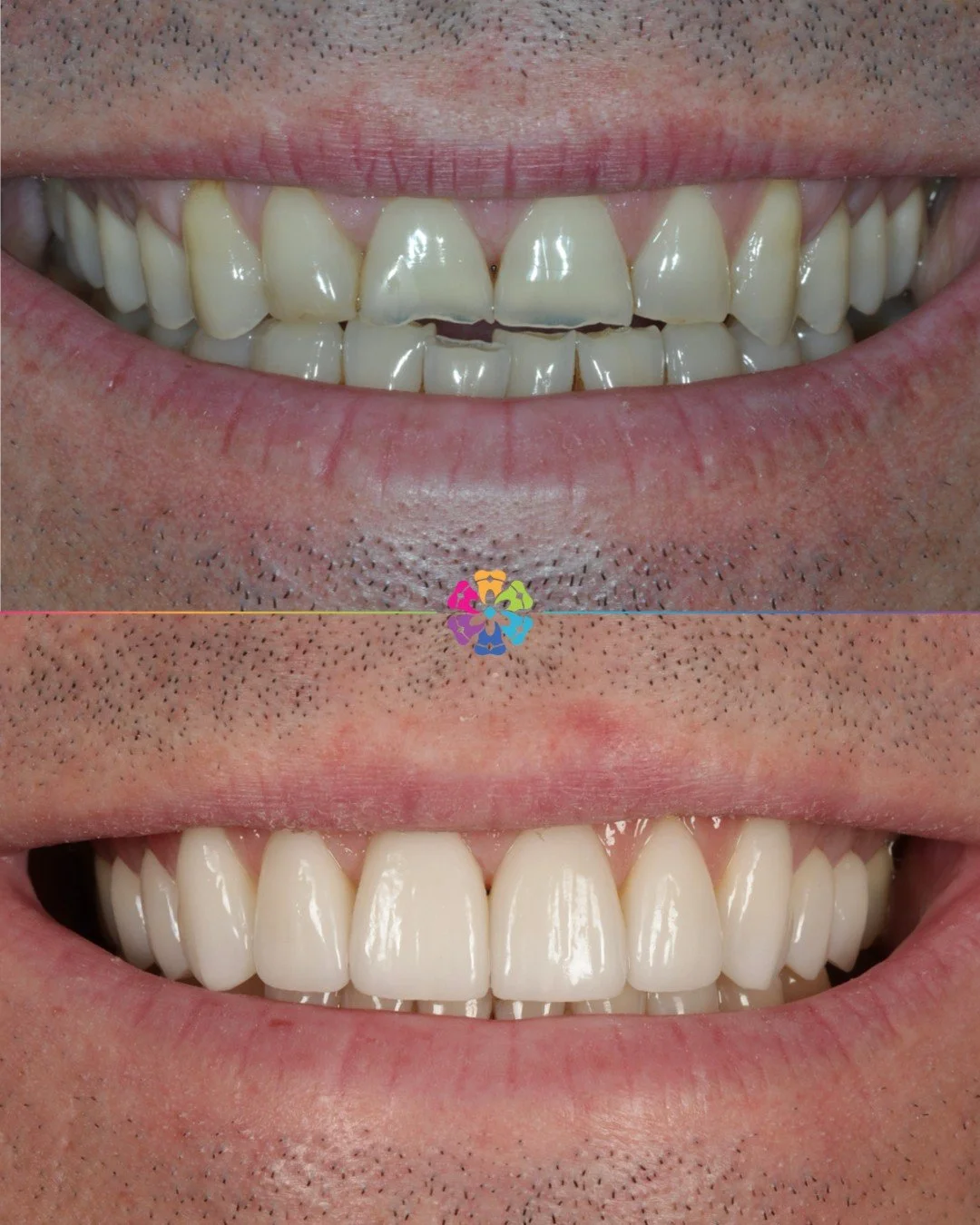 Smile Makeover 🦷🌟

This patient saw Dr Katy Sharpe for a cosmetic makeover!

A treatment plan was created to achieve this patients dream smile. 

To start with, Katy recommended Invisalign to get the teeth in a more desirable position and prevent a