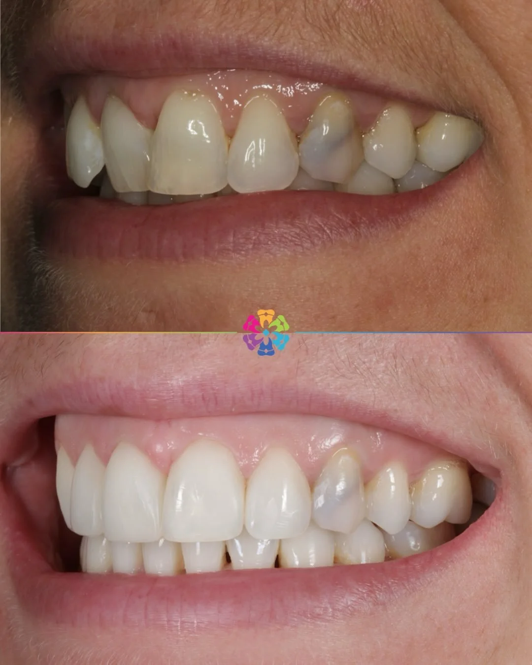 ✨ Smile Makeover ✨

Dr Katy Sharpe transformed this patient&rsquo;s smile using Invisalign, Whitening and Composite Veneers.

Creating bespoke, confident smiles 🌟

#dentalsmilesflagstaff #invisalign #smilemakeover #colchester #naturalresults