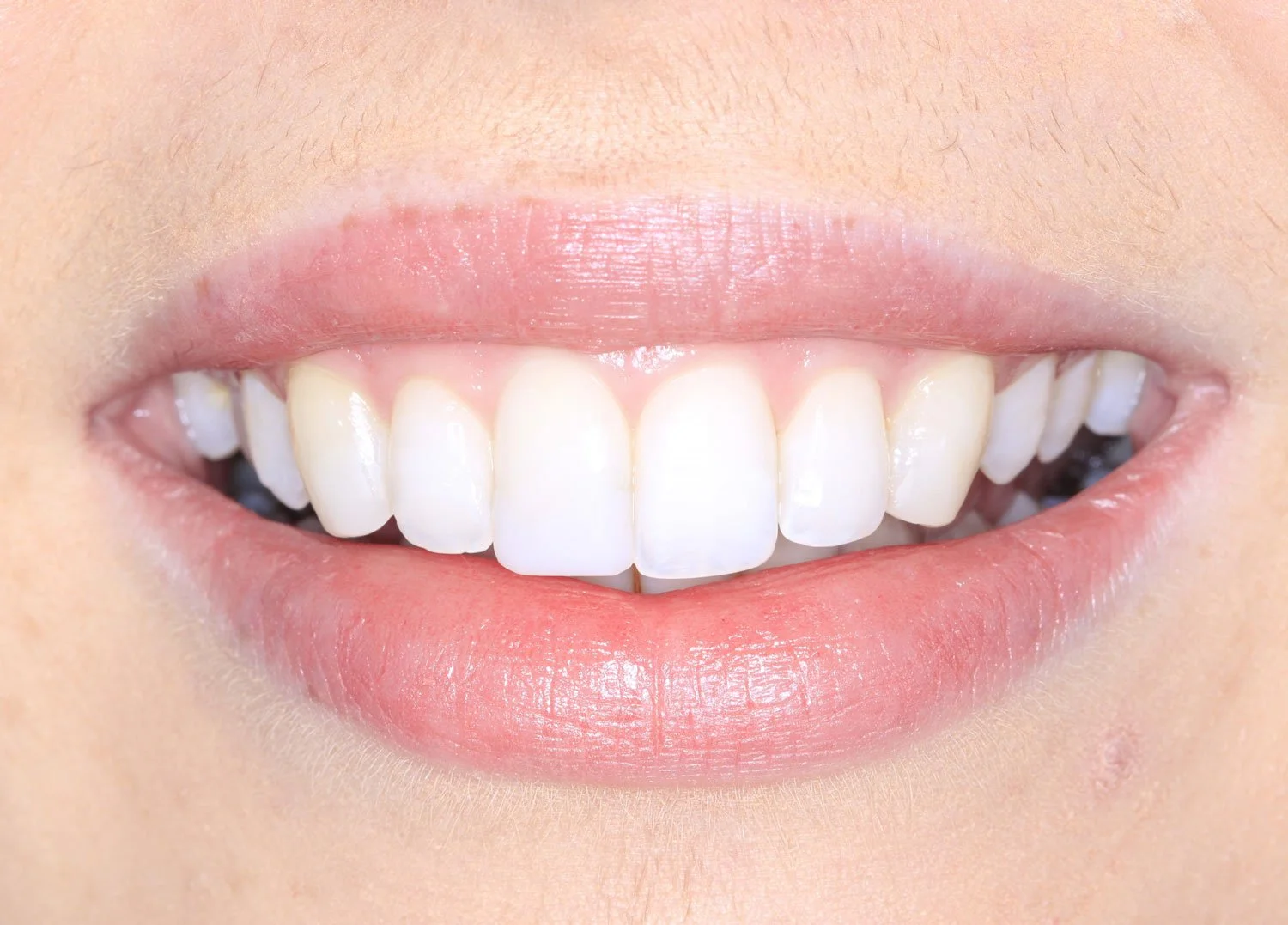 Invisalign clear braces composite bonding after