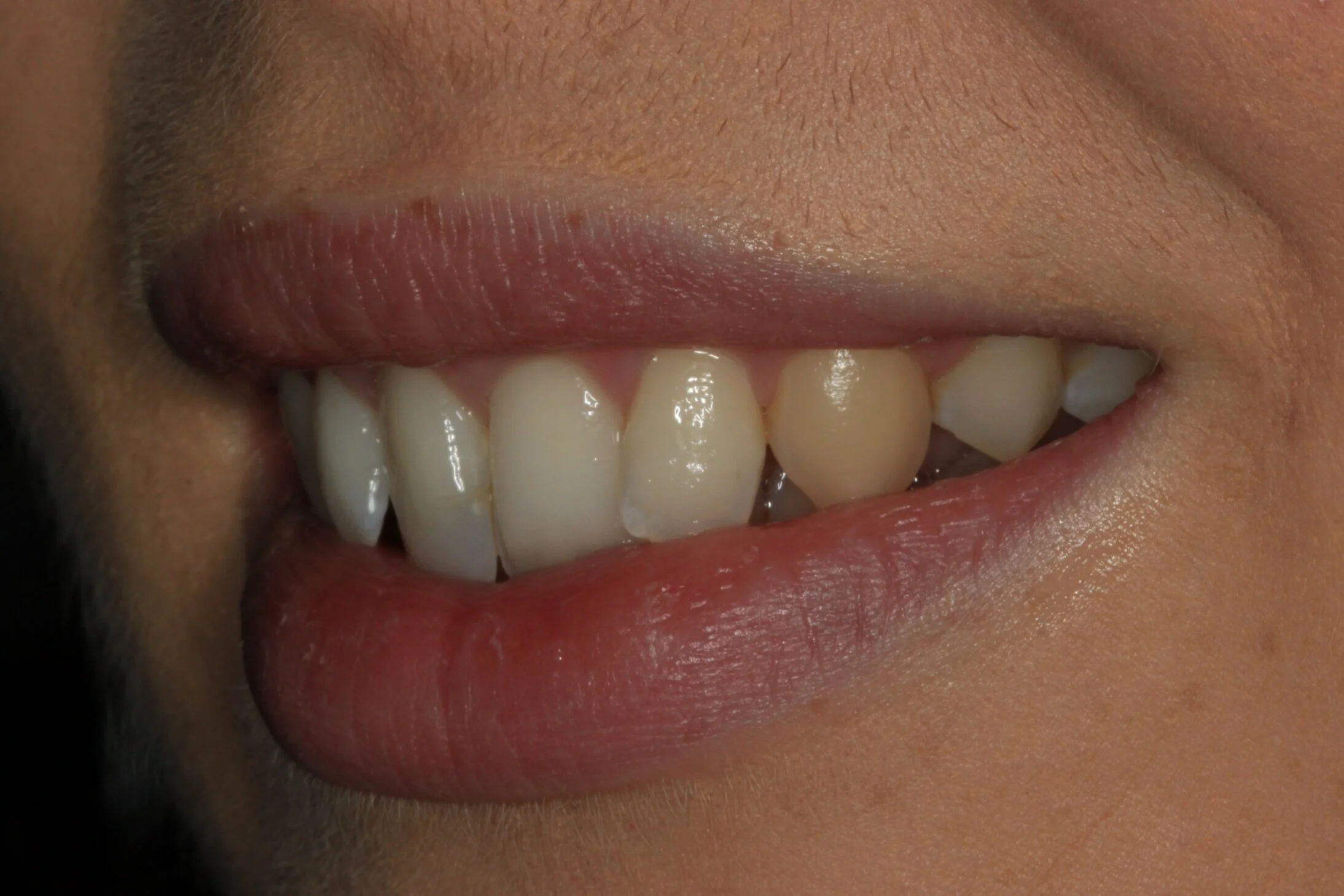 Invisalign and coomposite bonding before