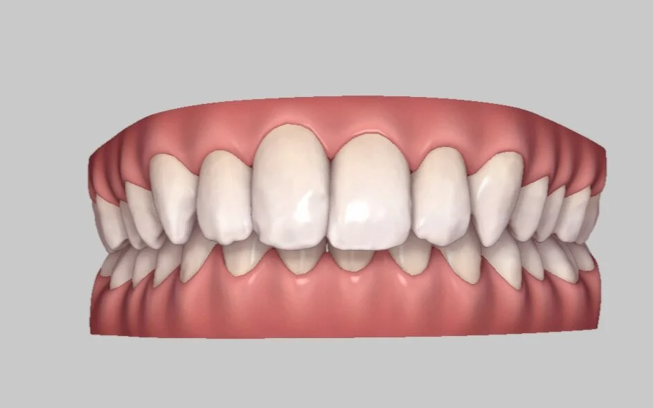 Invisalign Simulation – Clincheck