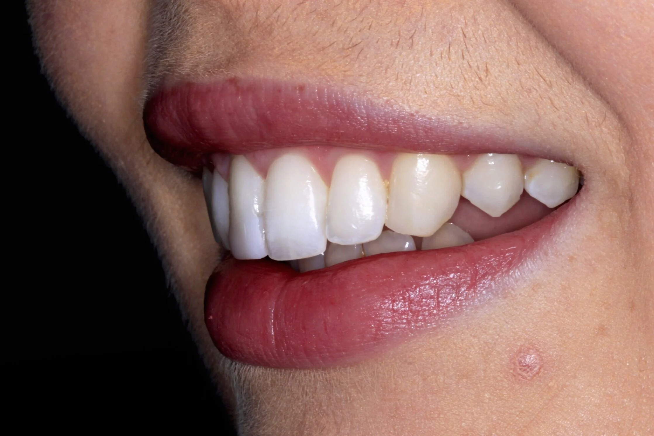 Invisalign and coomposite bonding after