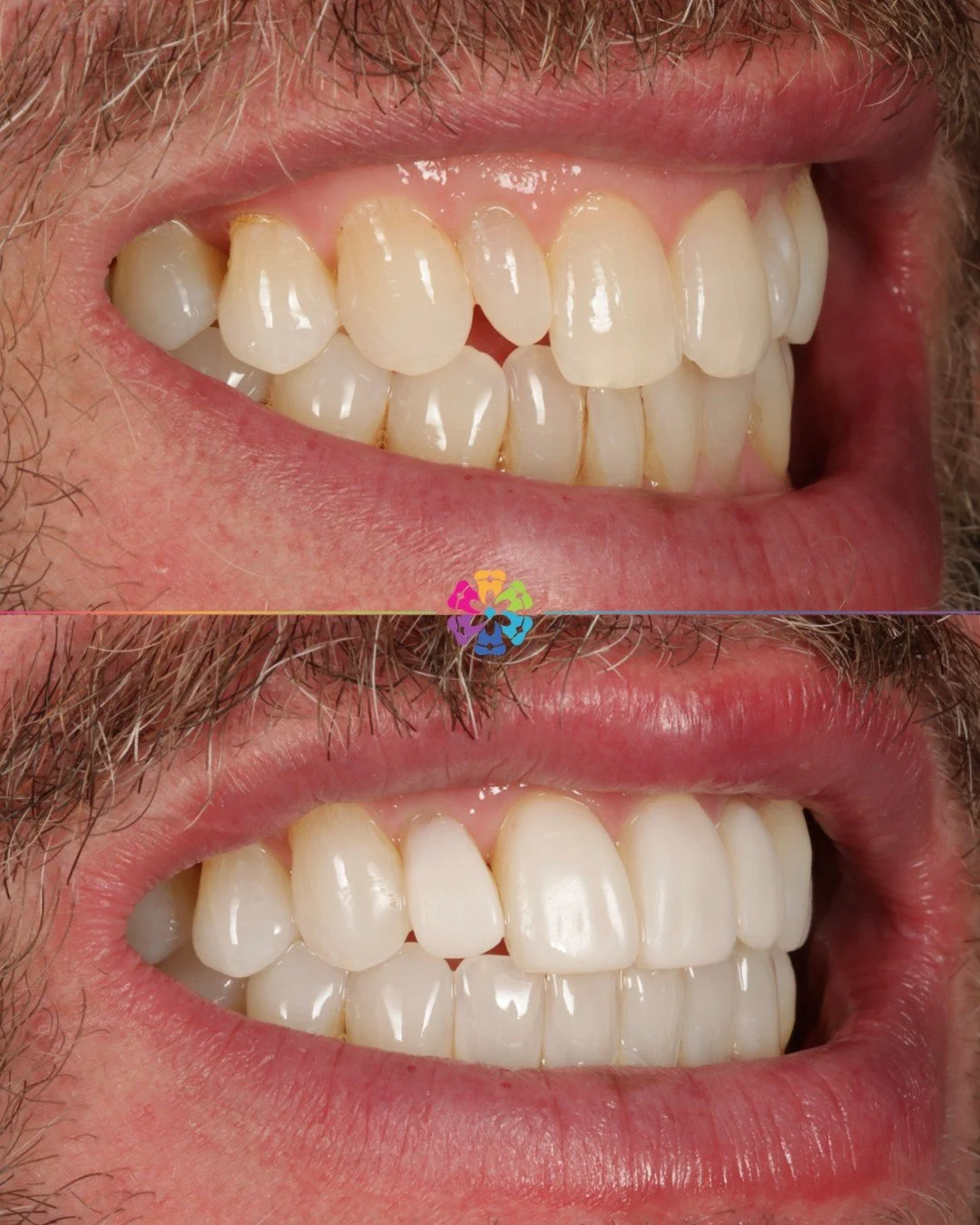 Composite Veneers ✨

Smile Transformed by Dr Katy Sharpe 

#dentist #dentalsmilesflagstaff #compositeveneer #naturalsmile #newsmile