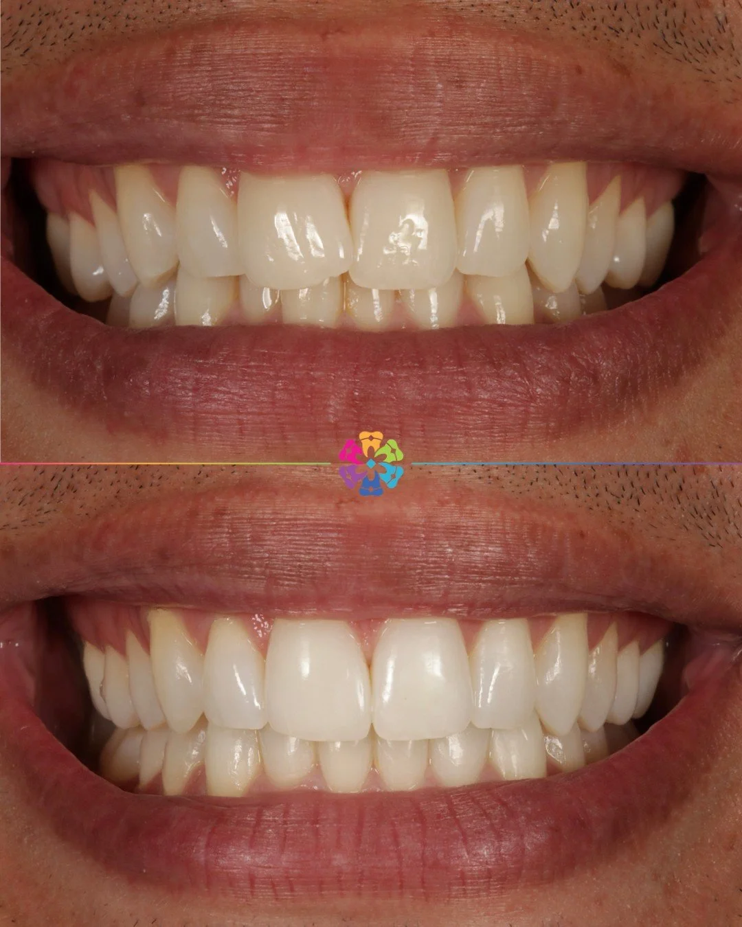 Invisalign &amp; Whitening Case 🚨✨🦷

Natural, confident smiles by Dr Katy Sharpe 

#dentistry #invisalign #naturalsmile #colchester