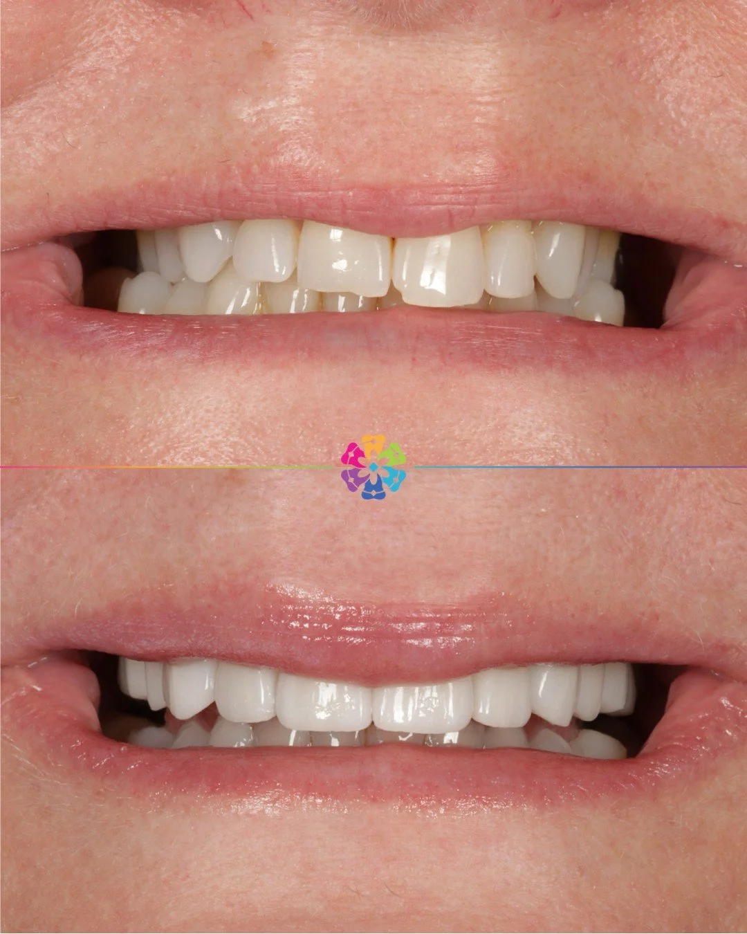 ✨ Smile transformation ✨
This patient achieved a brighter, more balanced smile with 6 porcelain veneers (upper 6&ndash;6).
Natural aesthetics, improved symmetry, and long-lasting results 🦷

Contact us to book in your consultation📲