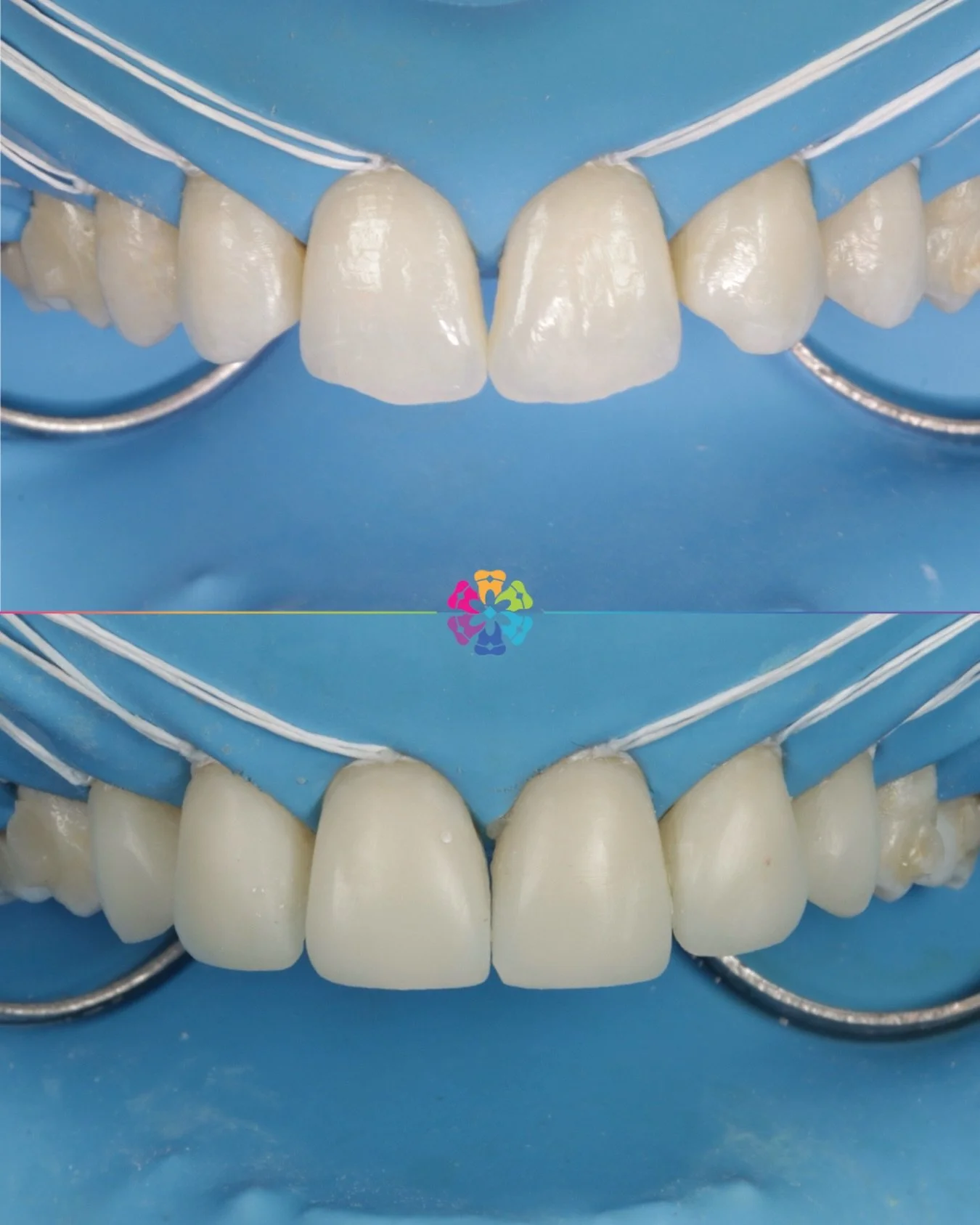 Composite Bonding &amp; Black triangle closure ✨

Composite Bonding done under rubber dam with floss ties to ensure:

✔️Moisture control

✔️Isolates the tooth to avoid contamination

✔️Protects the airway 

✔️Retracts lips and tongues to make access 
