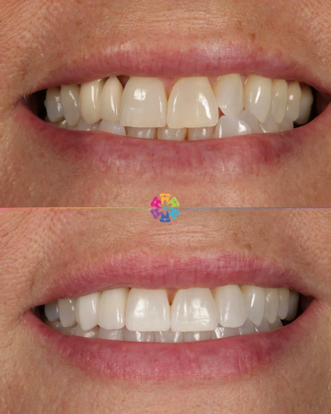 Invisalign, Whitening &amp; Bonding ✨🦷

Straighter, brighter and more balanced whilst still looking completely natural.

#dentalsmilesflagstaff #colchesterdentist #invisalign #newsmile