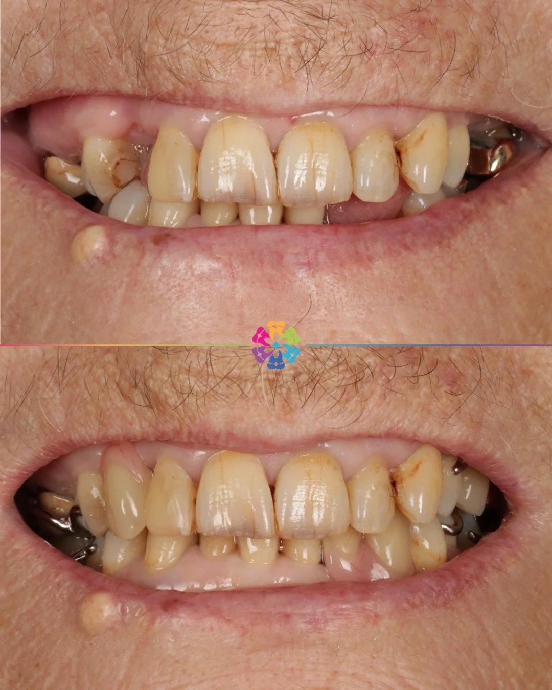 Smile restoration with a cobalt chrome denture ✨

This patient wanted a comfortable, durable solution to replace their missing teeth. We chose a cobalt chrome denture due to its many benefits over acrylic dentures &mdash; including improved strength,