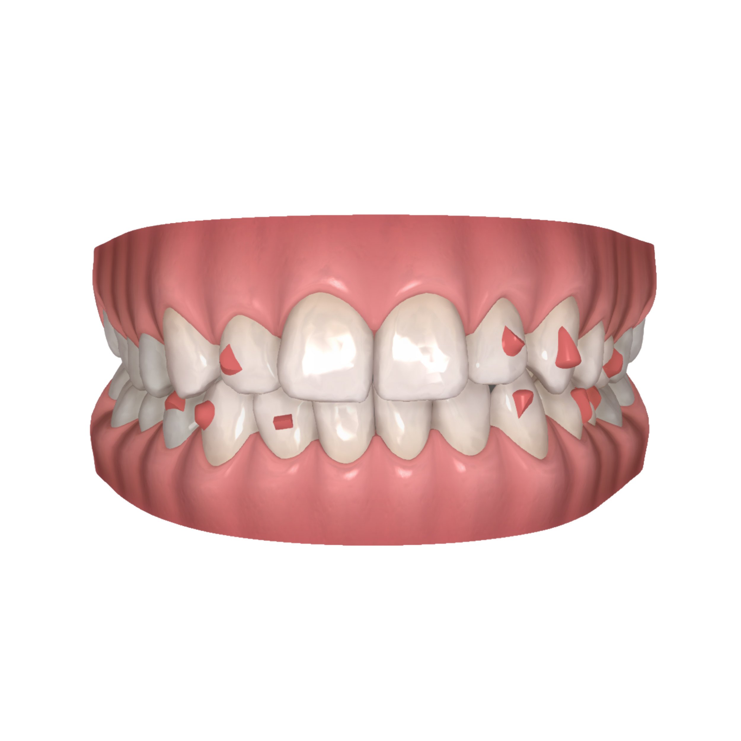 What are Invisalign attachments?