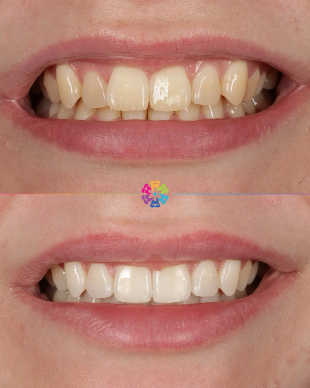 Invisalign, Whitening and Bonding