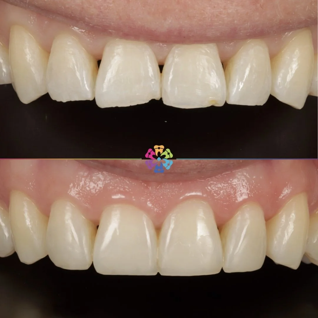 Composite Bonding ccase at Dental Smiles Flagstaff in Colchester Essex