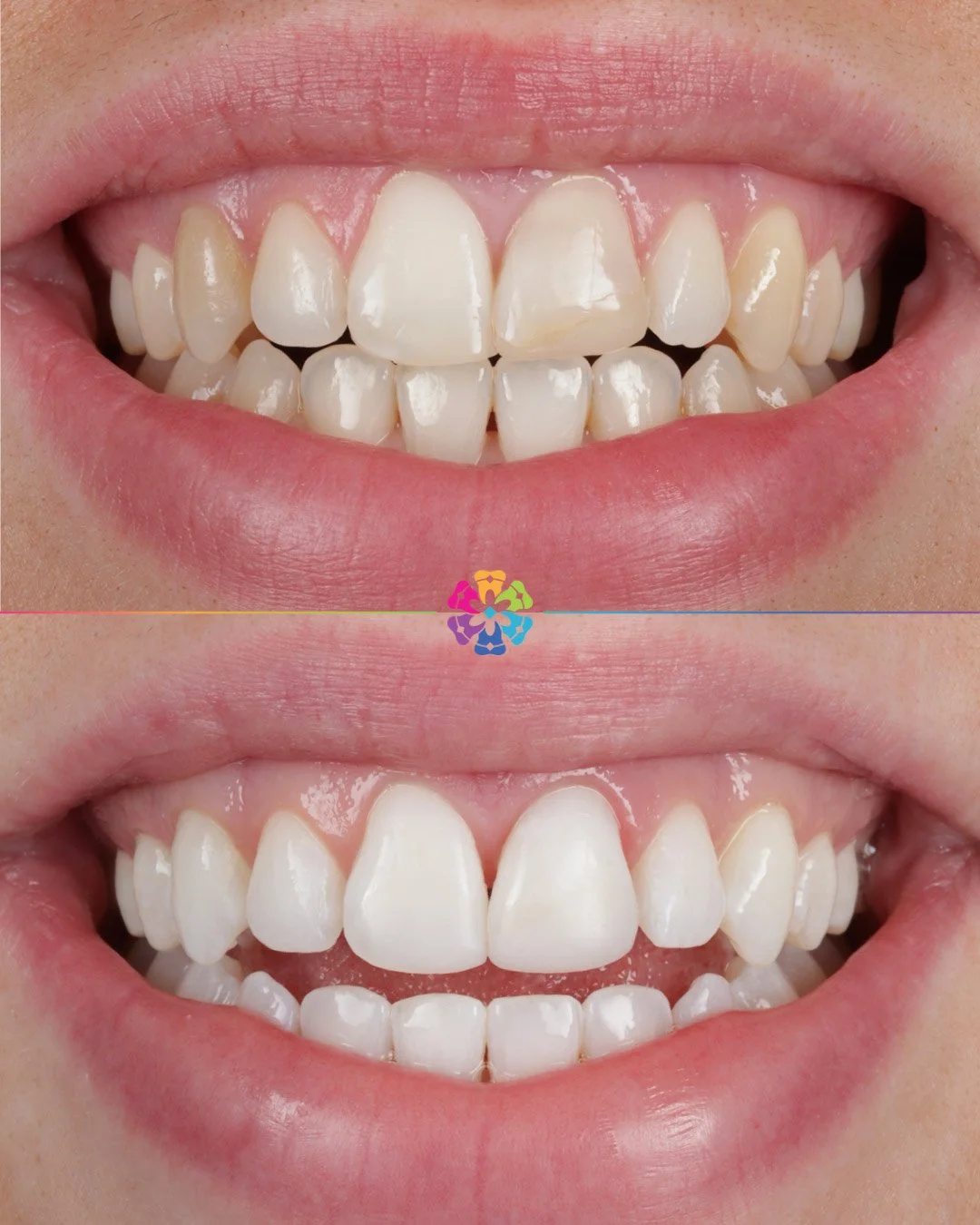Whitening