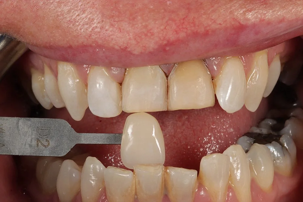 Temporary Veneers at Dental Smiles Flagstaff – Colchester, Essex