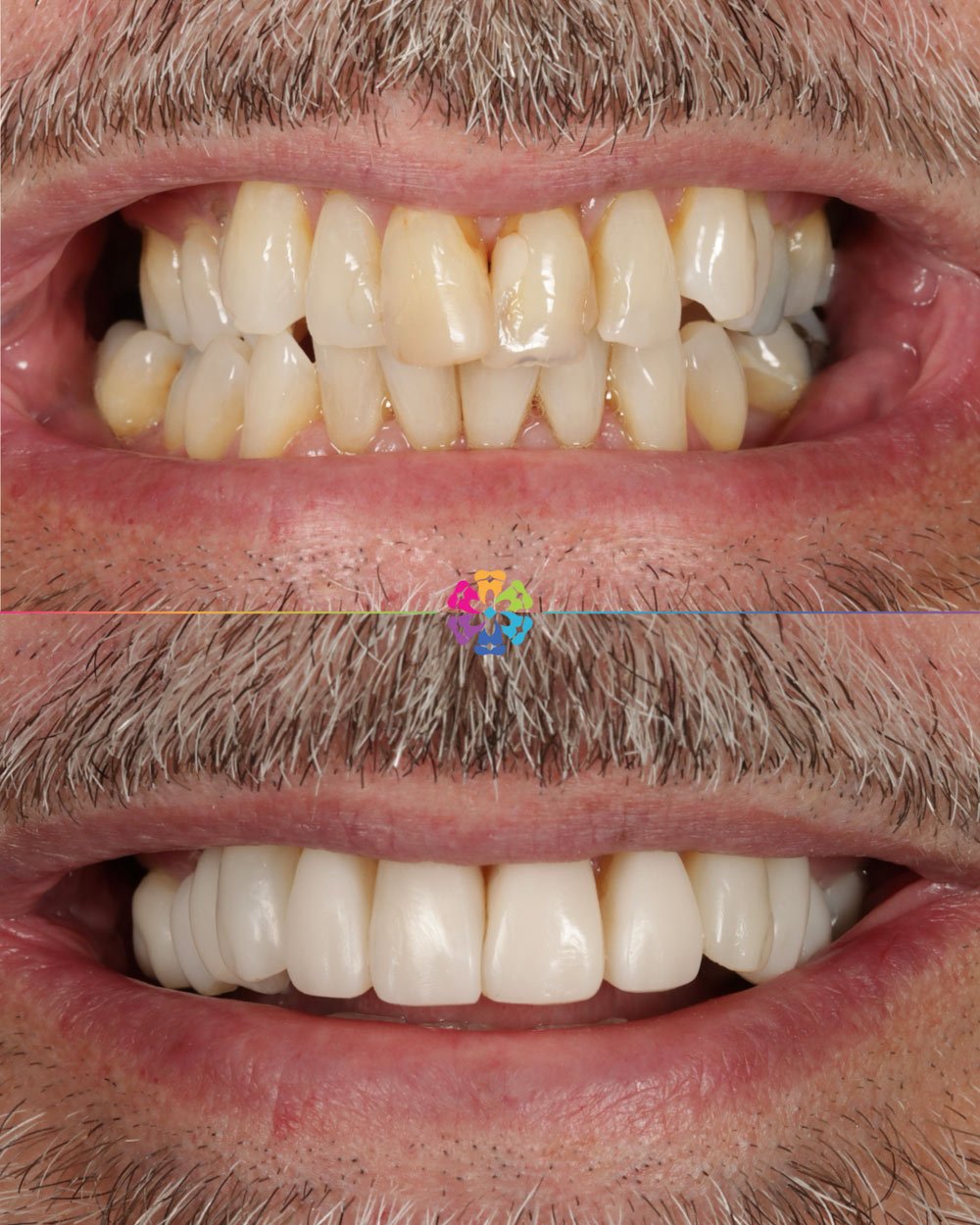 Composite Veneers at Dental Smiles
