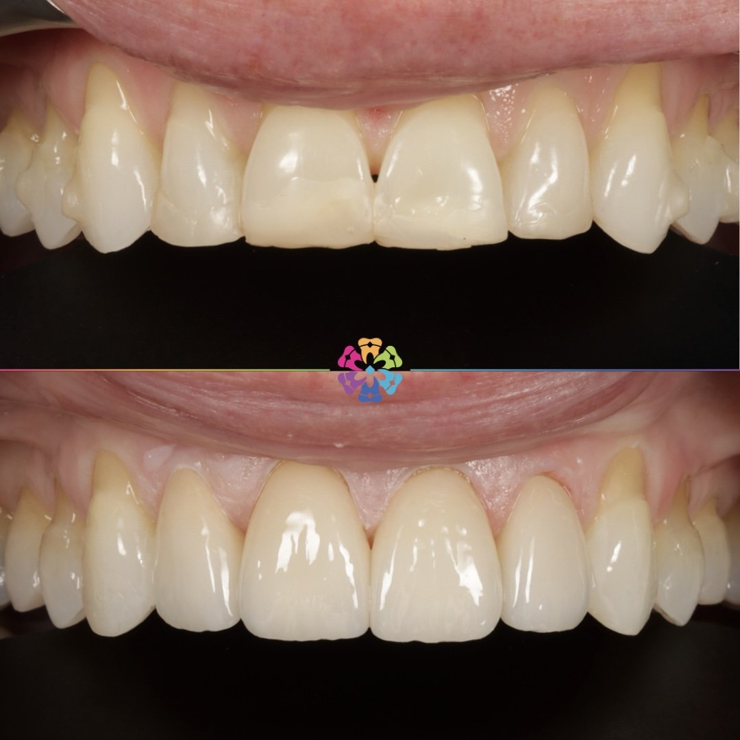 Crowns and porcelain onlays at Dental Smiles Flagstaff