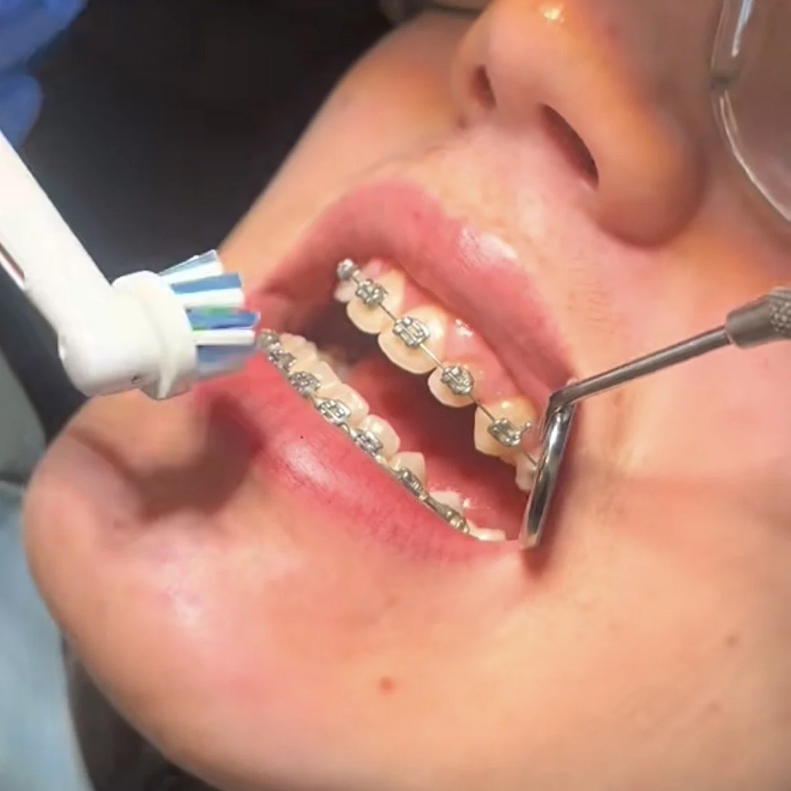 Cleaning Fixed Braces