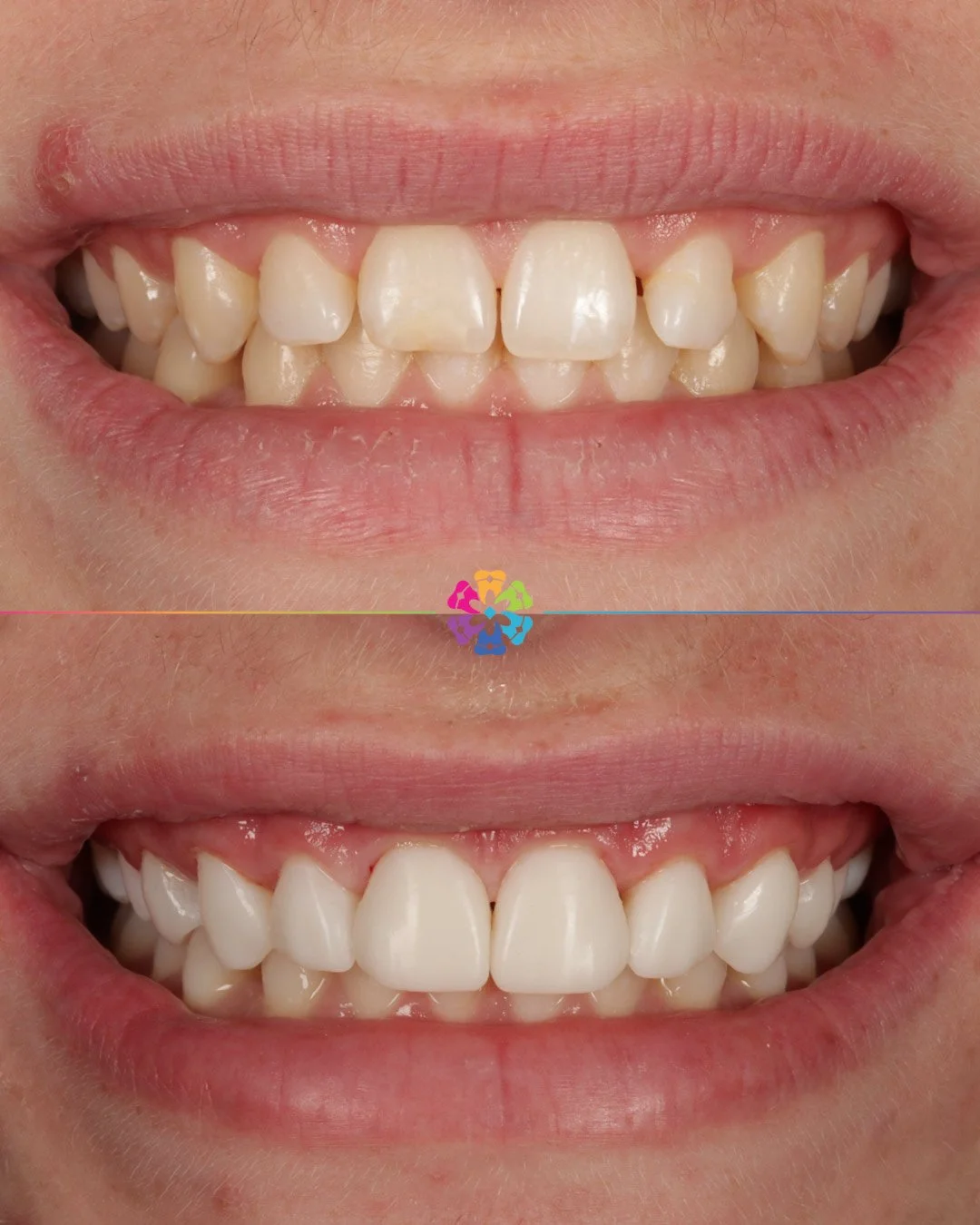 Composite Veneers at Dental Smiles