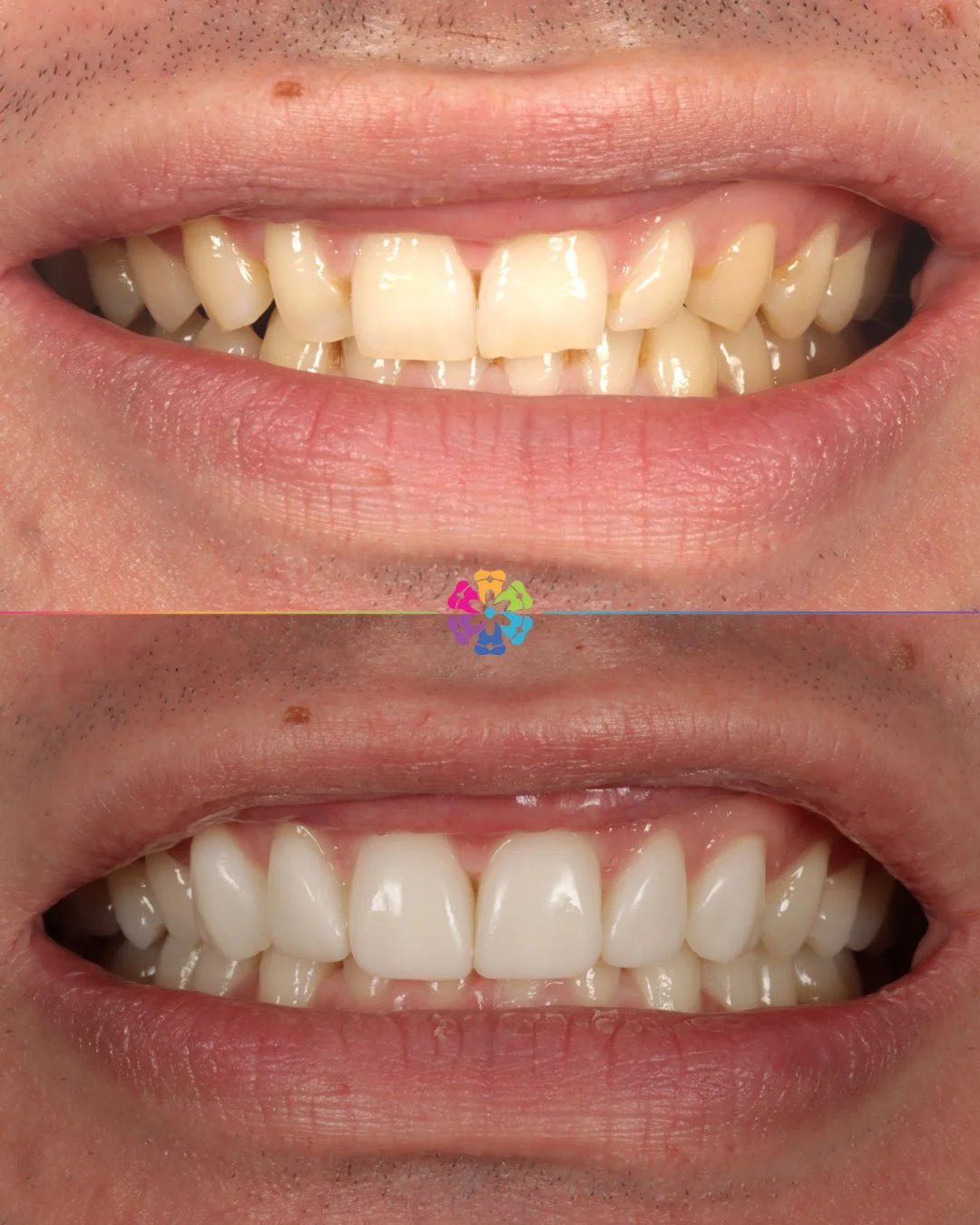 Composite Veneers at Dental Smiles