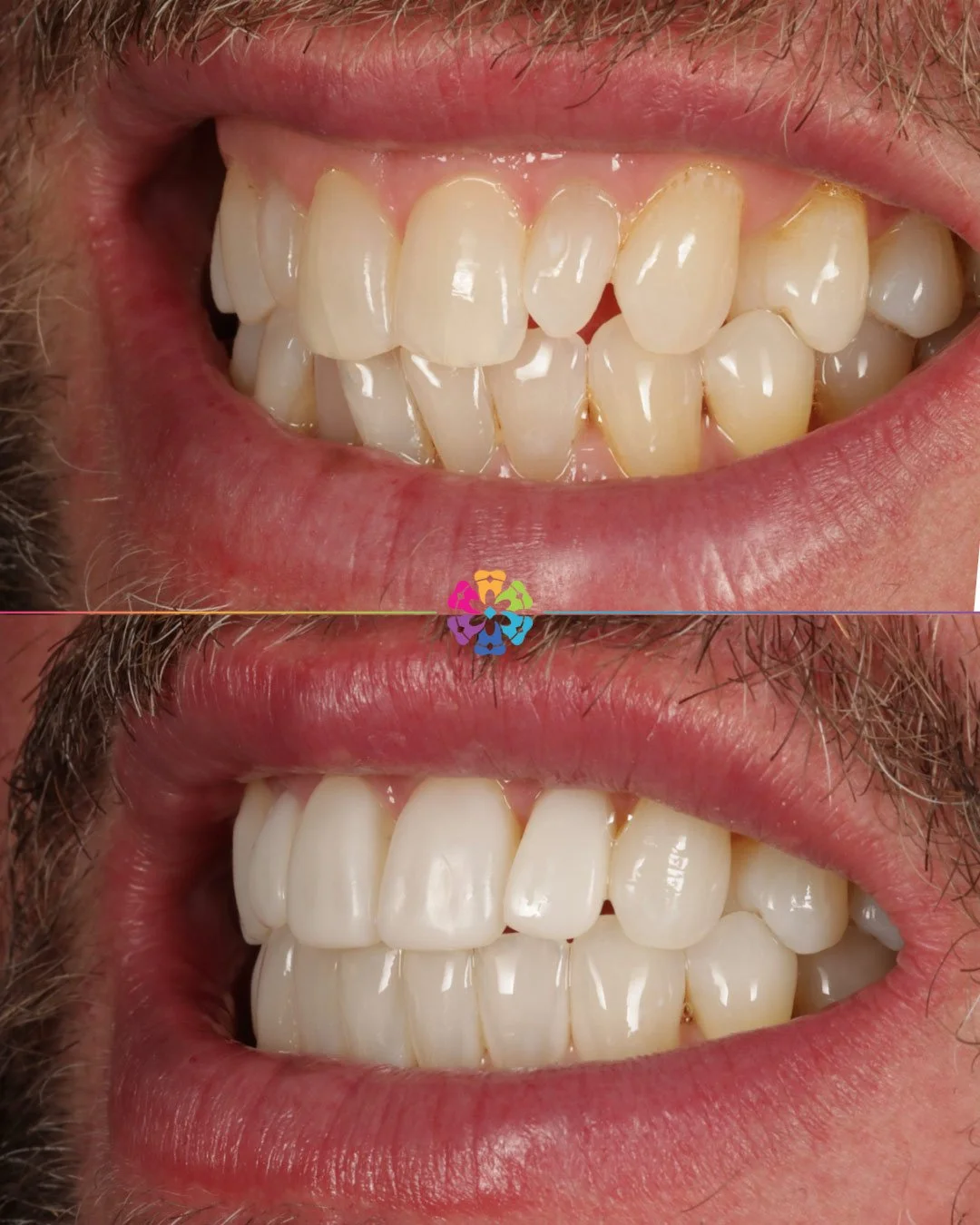 Composite Veneers at Dental Smiles