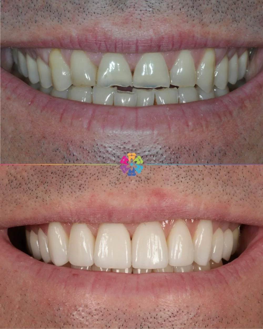 Smile Makeover