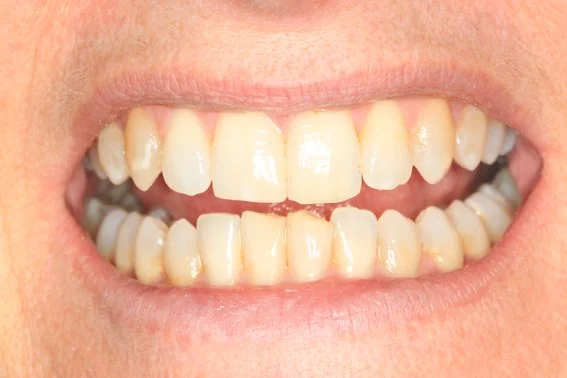 Overbite after Invisalign® in Colchester