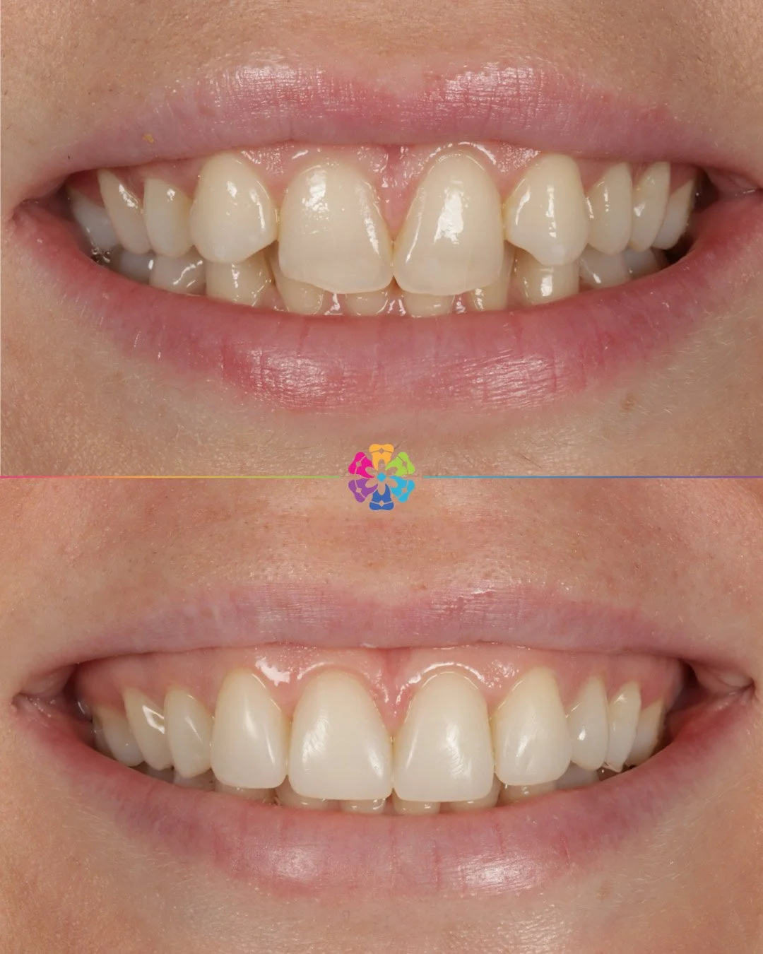 Invisalign, Whitening and Bonding