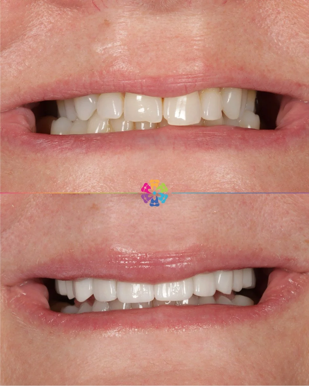 Porcelain Veneers