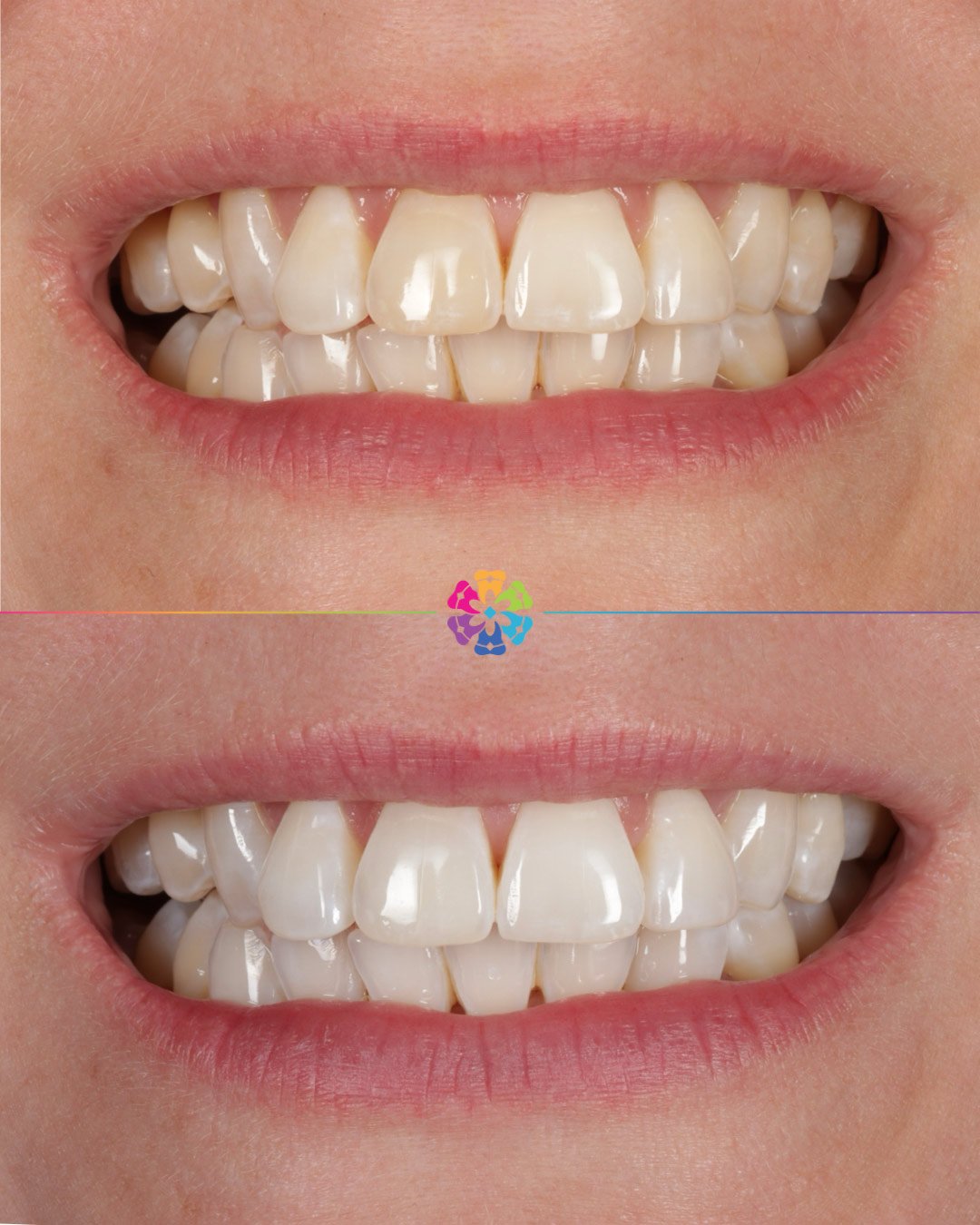 Whitening
