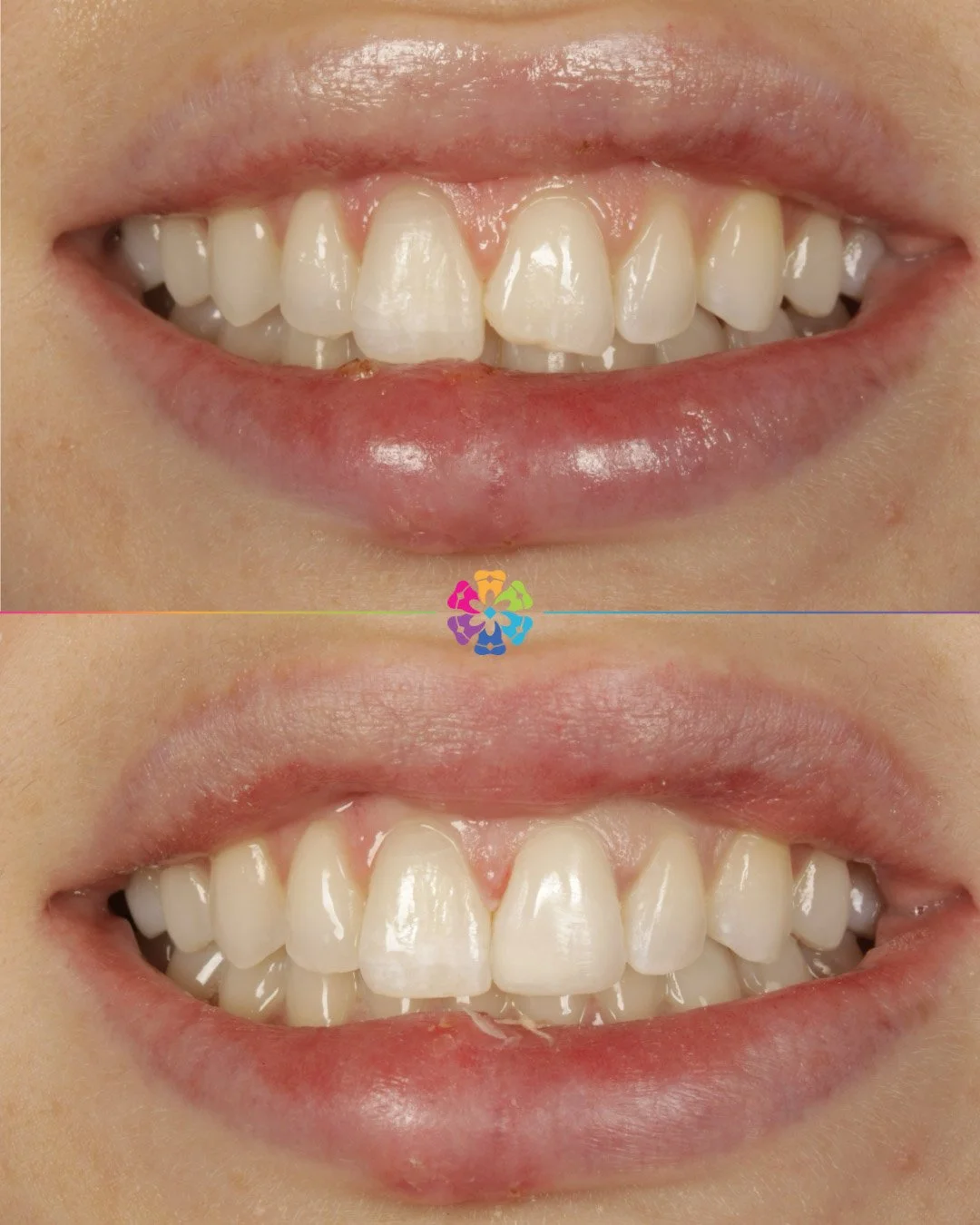 Composite Bonding