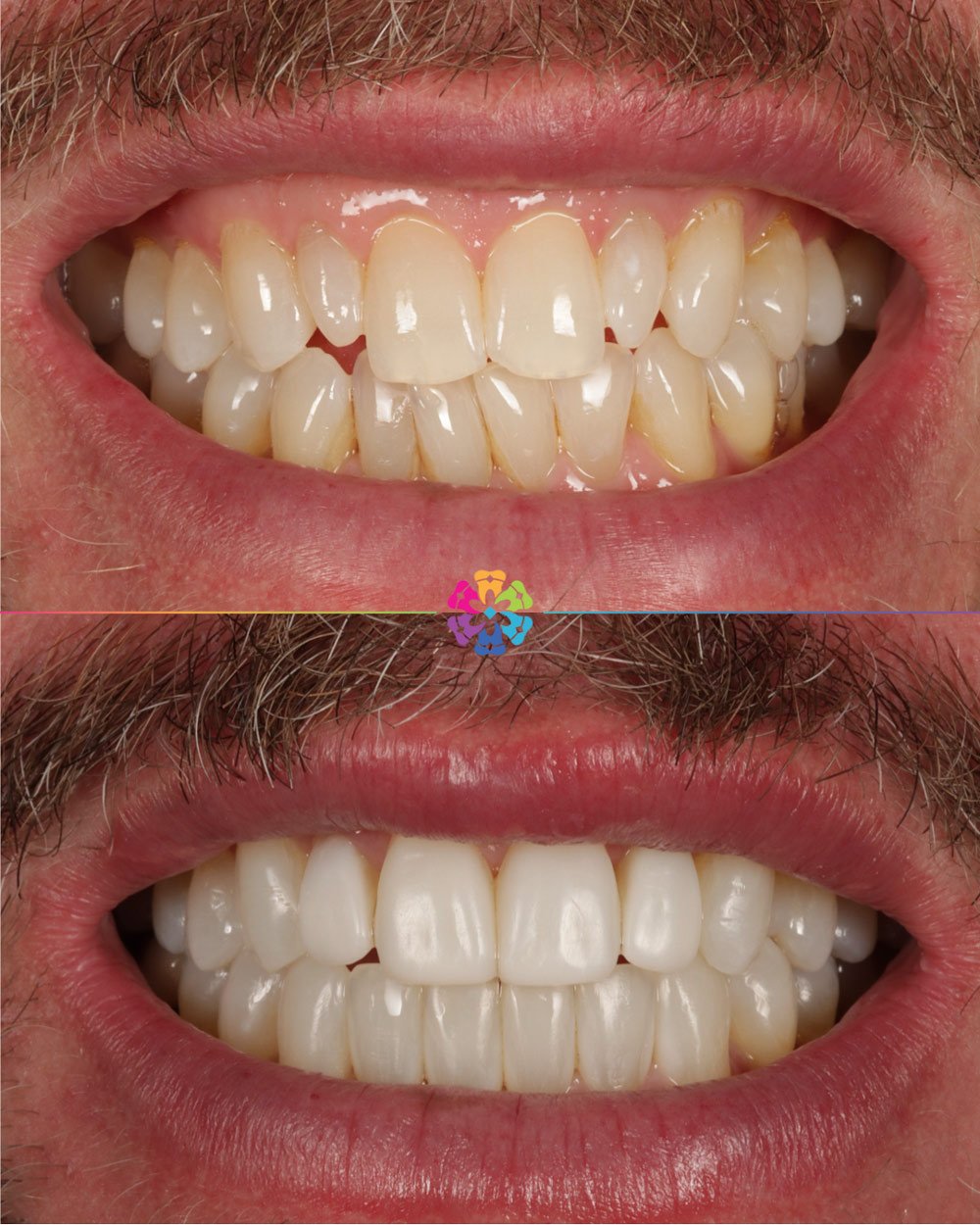 Invisalign, Whitening and Bonding