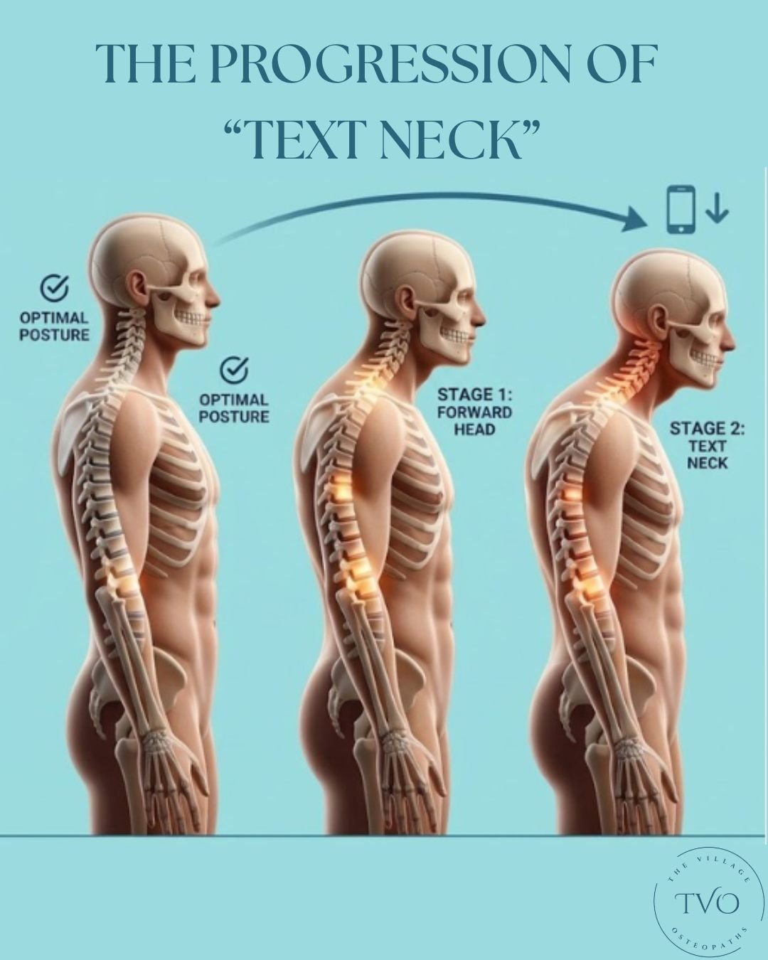 How often do you find yourself looking down at your phone right now? 📱👇 
That simple habit could be creating what we call "Text Neck." As you can see, even a slight forward tilt of your head drastically increases the pressure on your spin