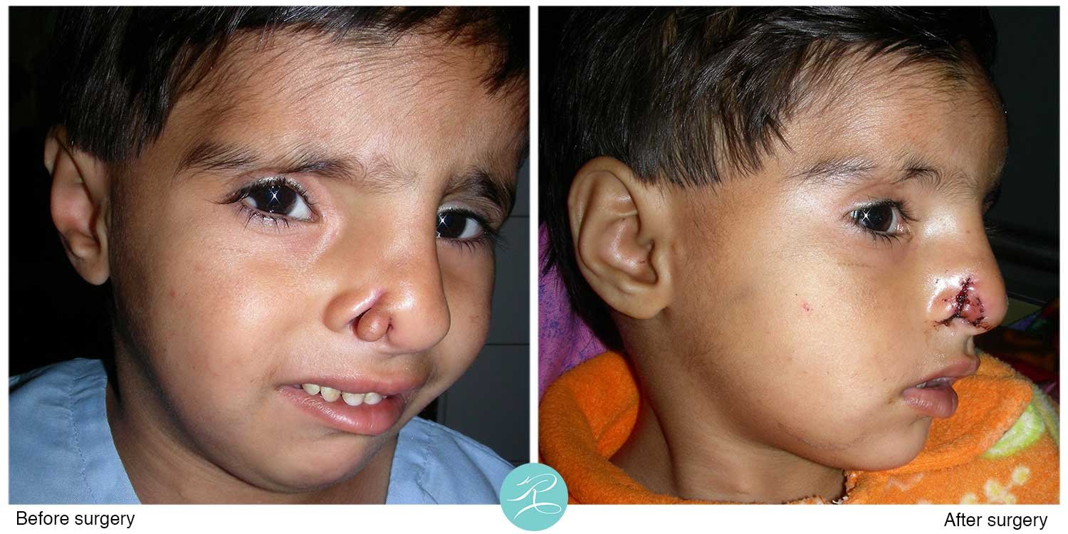 Cleft-nose-with-a-polyp.-Polyp-skin-used-for-reconstruction.jpg