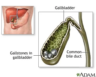 Diagram of the gallbladder's position and gallstones