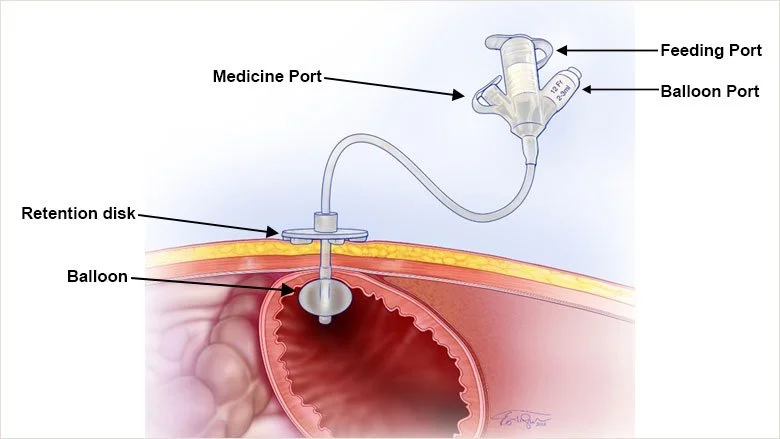 PEG Tube Basics Types And Placement Spoonful