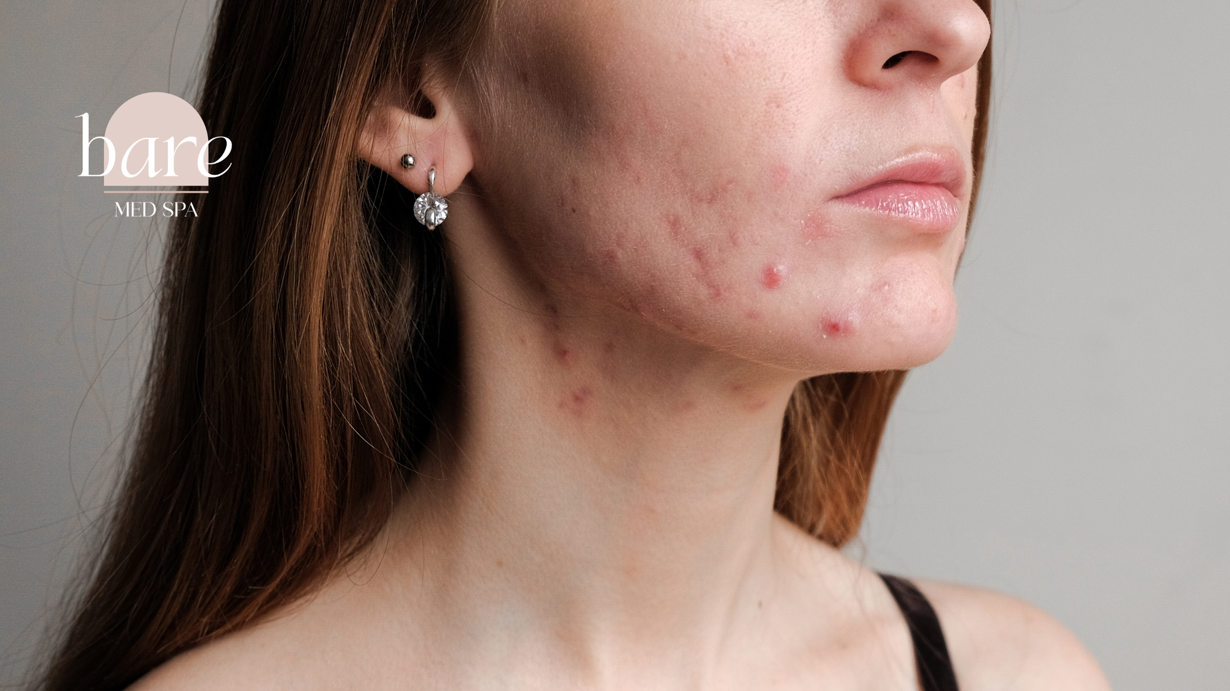 Adult acne blog guide with a close-up of acne-prone skin and tips for what actually helps.