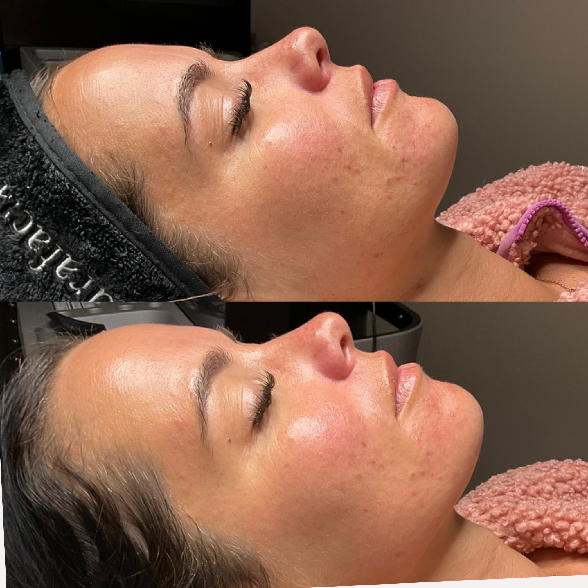 A client before and after post a Hydrafacial and Aerolase laser treatment. 