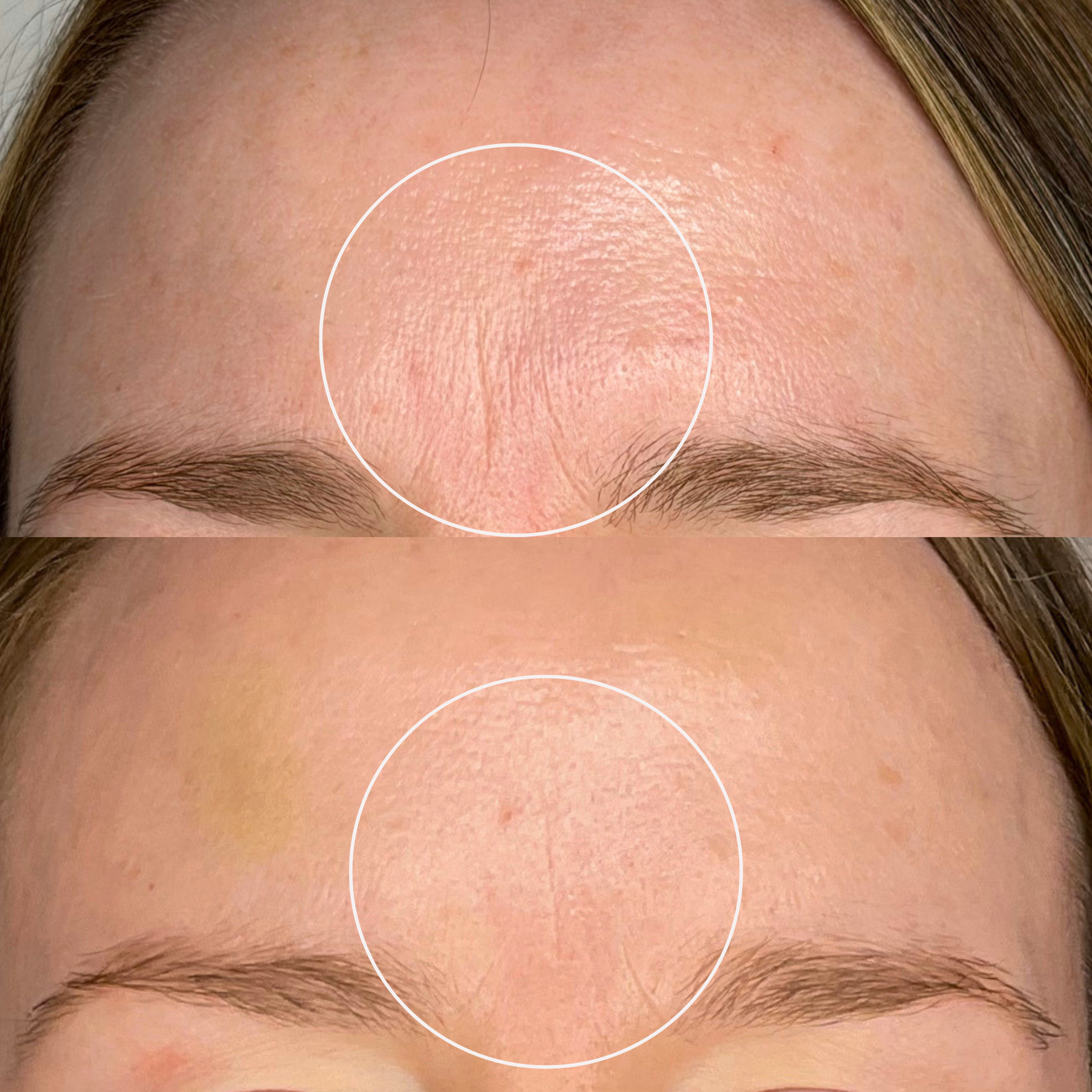 Mid-40s client came in with concerns of fine lines, wrinkles, and uneven skin tone. After our listened medical aesthetician did a thorough skin assessment, we suggested the client do a treatment series of aerolase and Hydrafacials. 