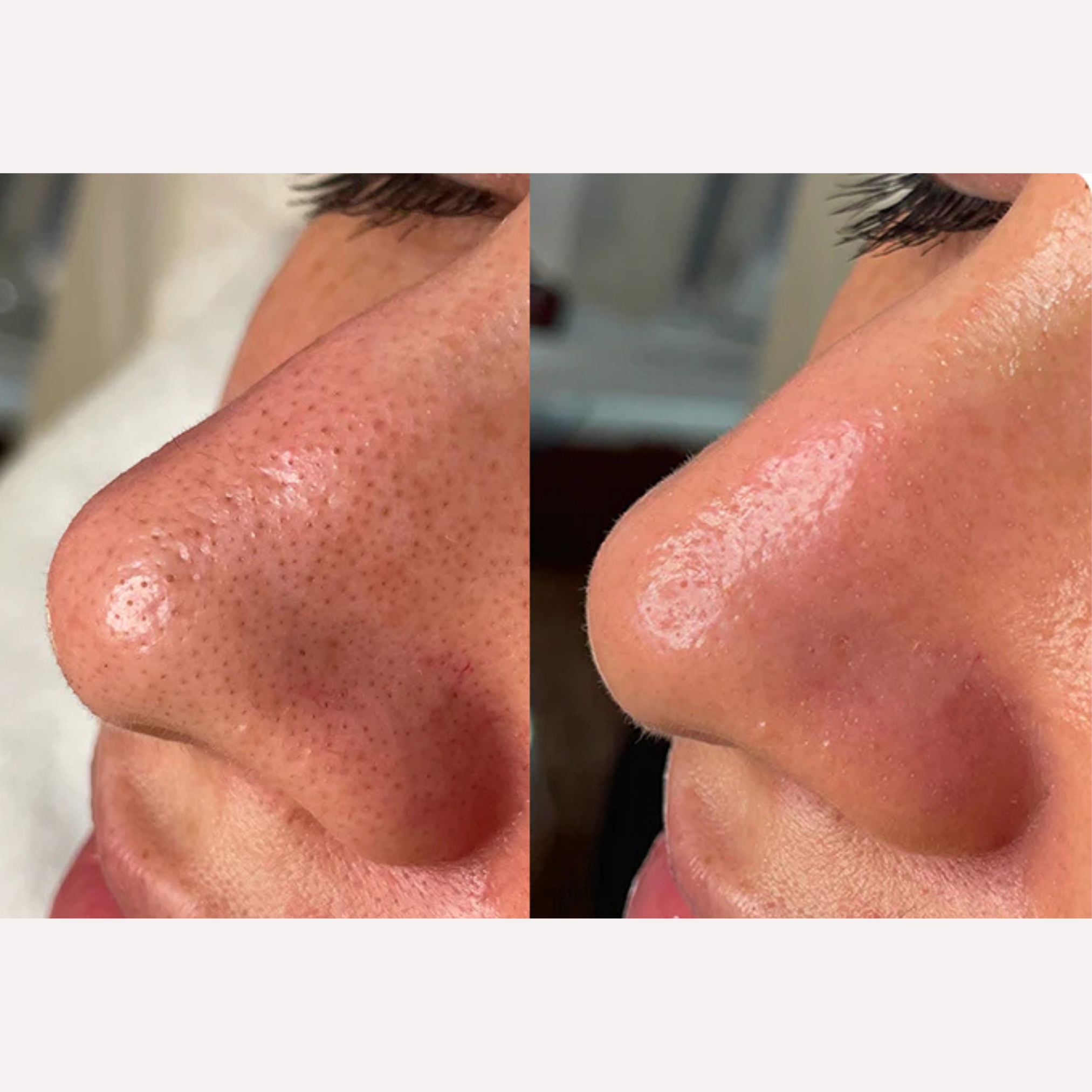 Client before and after. Client came in with clogged and visibly black pores on their nose. After a Hydrafacial that includes painless extractions, the client shows a smooth, clean, nose with visibly smaller pores.  