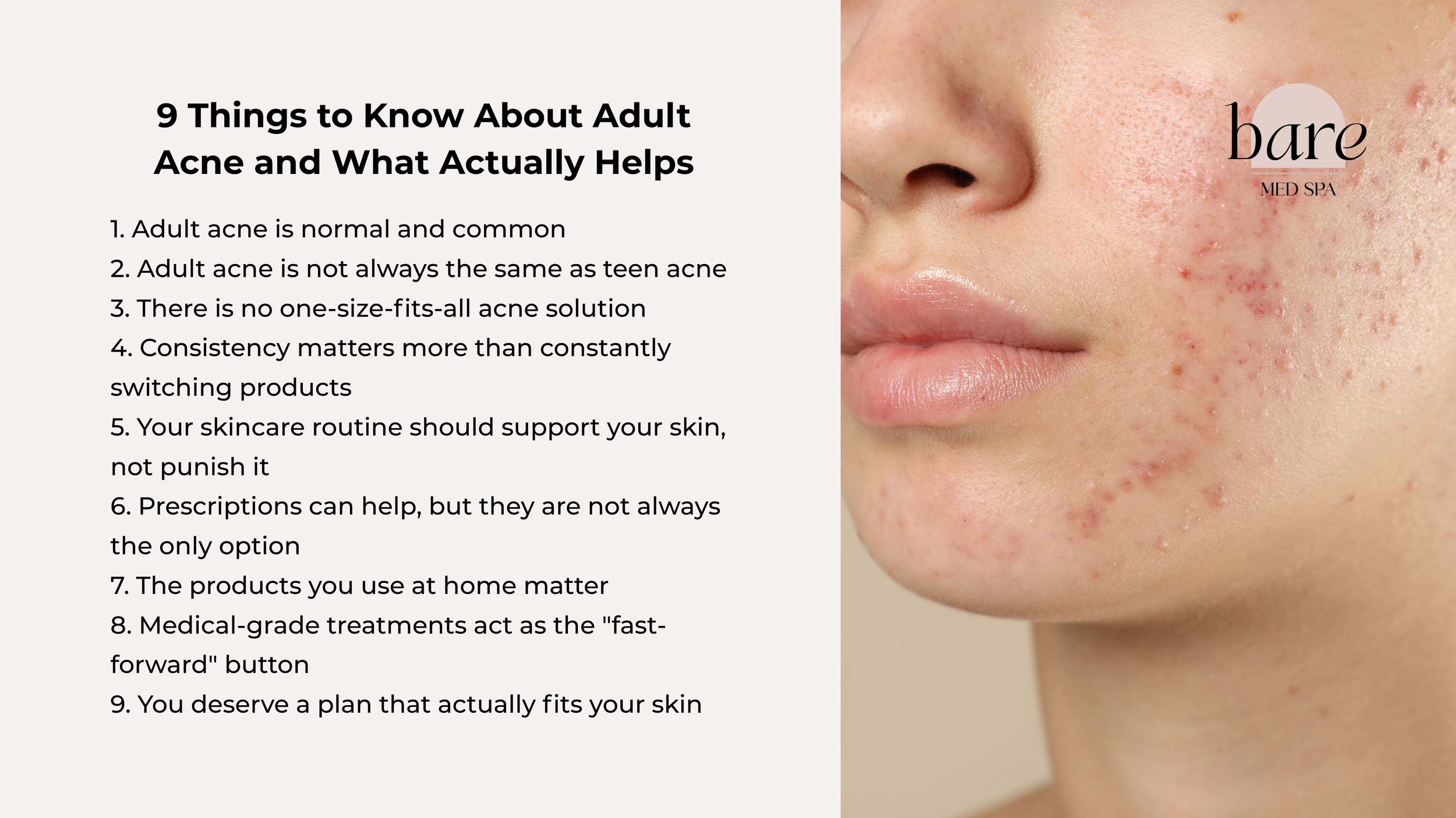 Adult acne treatment guide from a Libertyville med spa with tips for clearer, healthier skin. 9 tips from a professional.