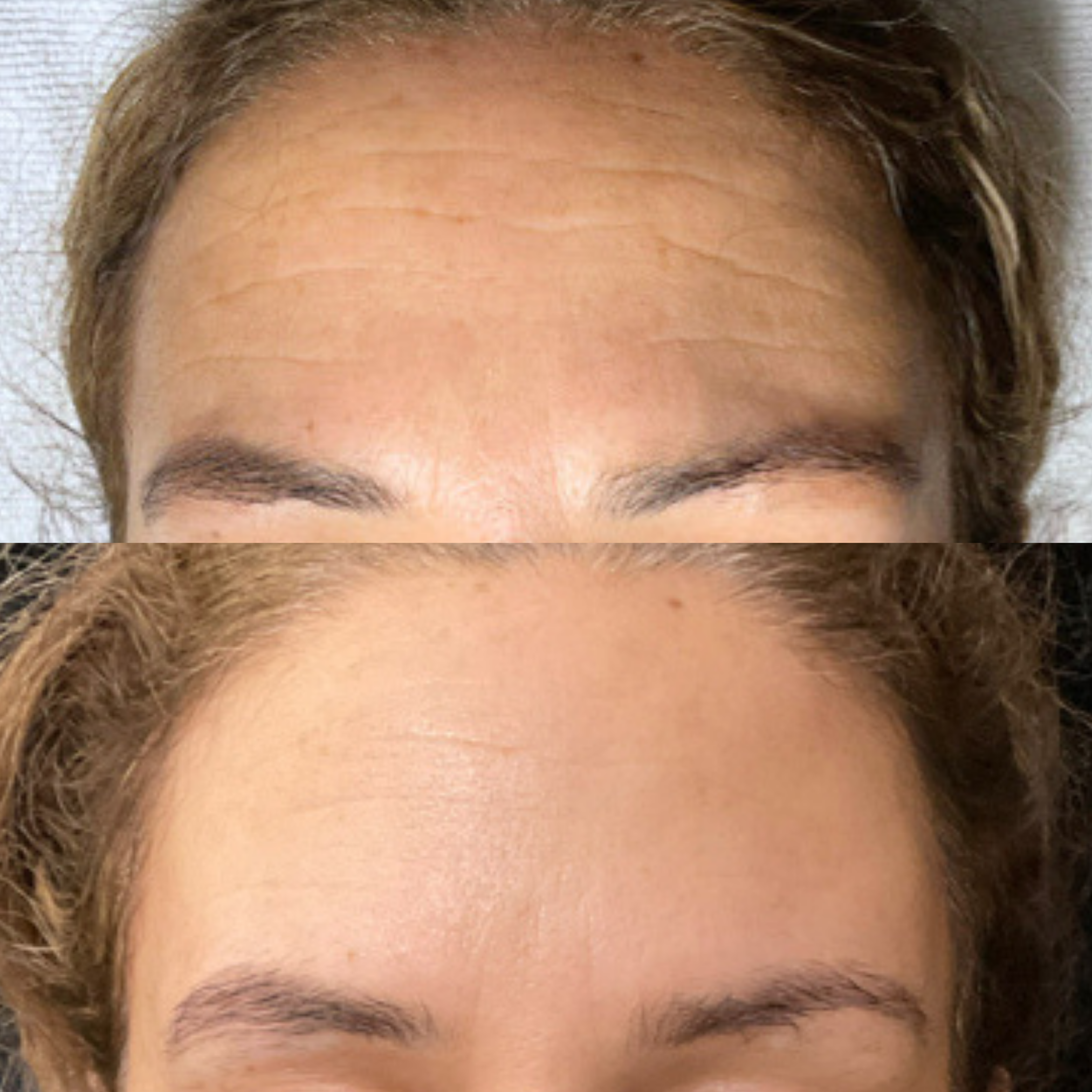 Before and after photo. Before picture shows deep fine lines and wrinkles and dehydration. The after picture shows a smooth forehead with noticeably less wrinkles and plumper skin. Treatments include Aerolase Laser and Hydrafacials.