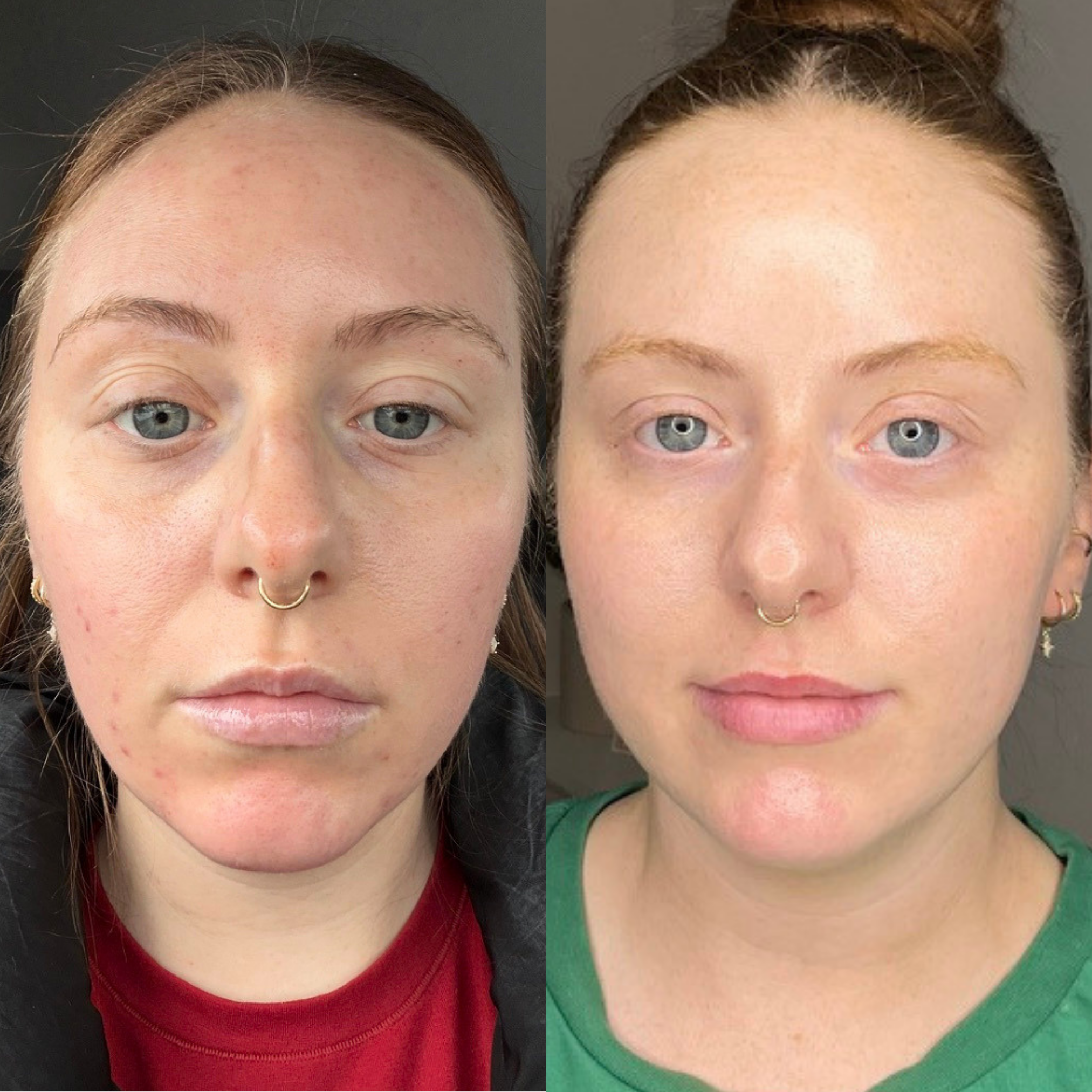 Before and after photo feature the a clients whole face. The before shows breakouts, pimple, uneven skin tone, and dehydration. The after shows a clear, glow, and even skin tone. Treatments include Aerolase Laser, custom facial, and microneedling. 