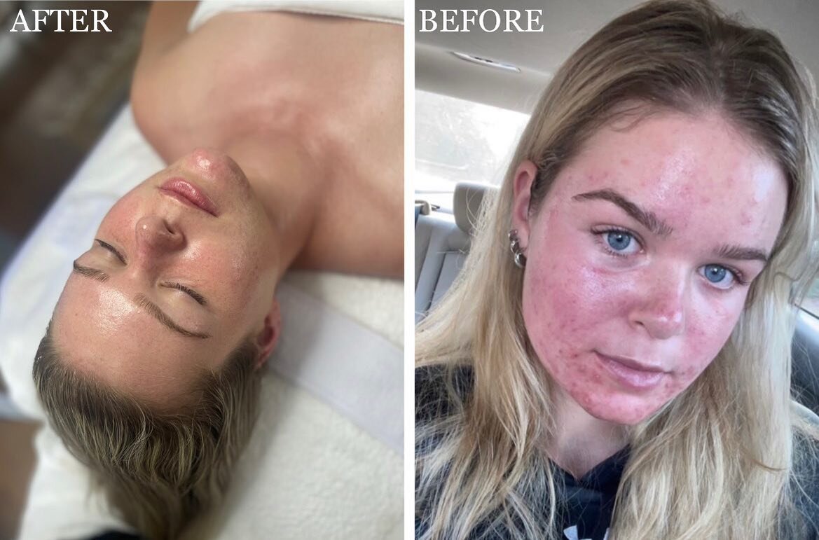 ‼️Incredible Results‼️⁣⁣
I couldn&rsquo;t be happier for her and this glow up😍🥰 ⁣
⁣
Acne is one of the most complicated and frustrating skin conditions. ⁣⁣With monthly Hydrafacials, a full change to her skincare + exfoliation routine at home and a 