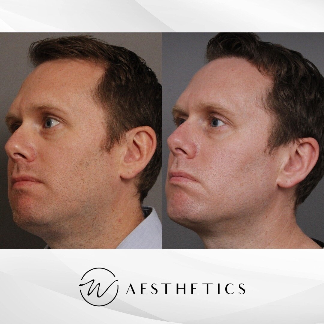 Last week we showed you a testimonial from @werschleraesthetics and Jay about the PicoLO Premium. Now, here are their laser toning results!⁠
⁠
DM us or call (866) 599-5570 to get more information on how the PicoLO Premium can help your patients!⁠
⁠
?