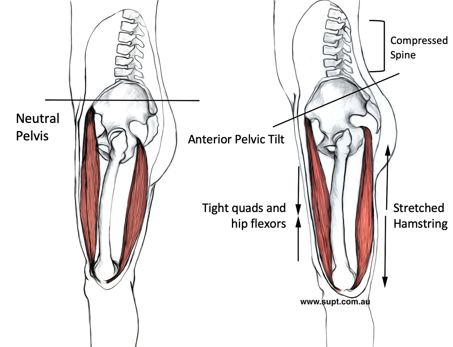 What is an ‘Anterior Pelvic Tilt’ and How to Correct it. — BodyWork