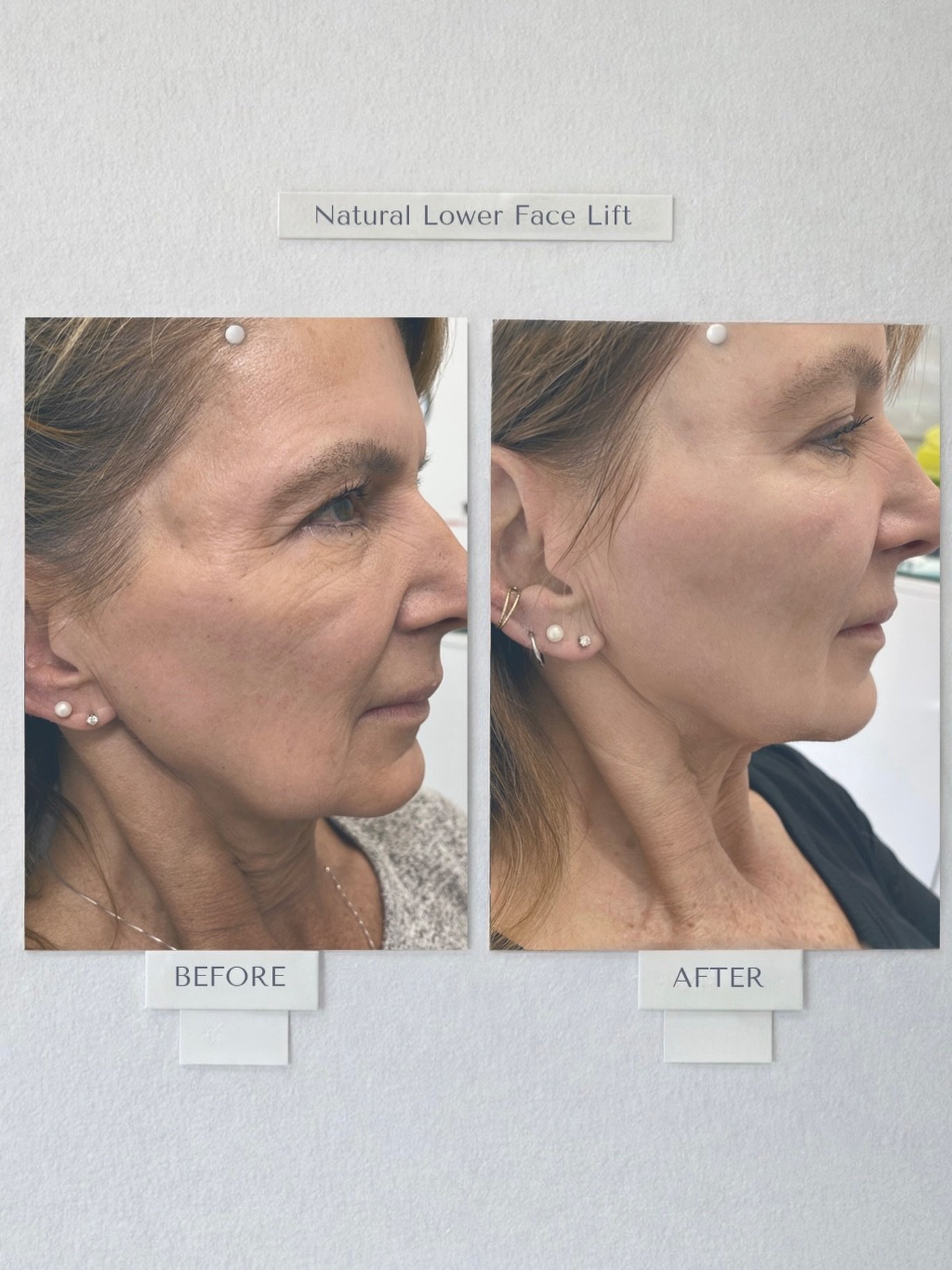 Lower face jowling is one of the most common concerns as we age &ndash; and it&rsquo;s often the result of gradual volume loss.

The key to achieving a natural- looking lower face lift isn&rsquo;t just treating the jowls, its about assessing the ent
