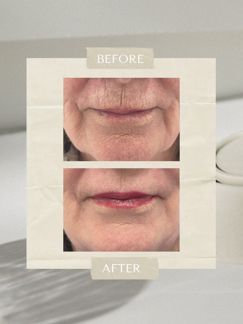 PlexrPlus is an advanced technology that uses plasma energy to cause immediate tightening and contraction of the skin and stimulate your skin&rsquo;s natural regeneration.

Skin regeneration continues over weeks to months as collagen and elastin are 