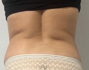 After 8 Endermologie sessions