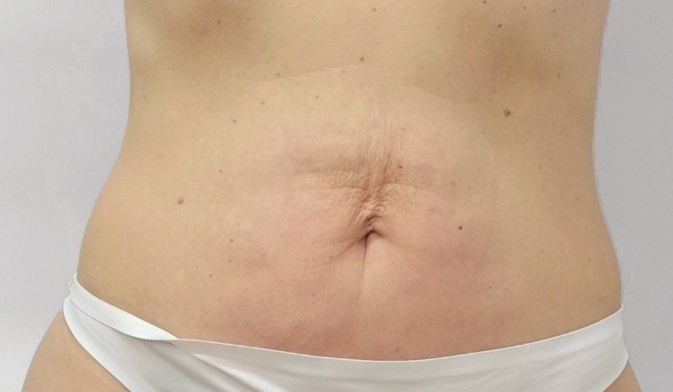 After 12 Endermologie sessions