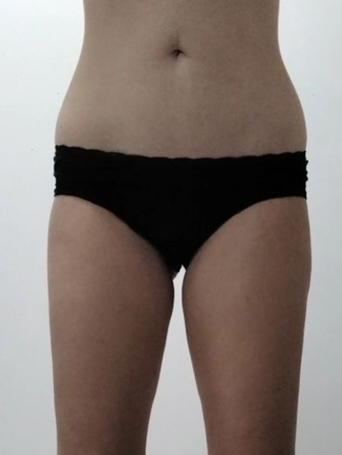 After 8 Endermologie sessions